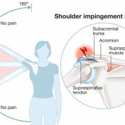 what-are-the-treatment-options-for-shoulder-impingement.jpg What are the treatment options for shoulder impingement?