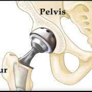 what-is-the-recovery-time-after-hip-replacement-surgery.jpg What is the recovery time after hip replacement surgery?