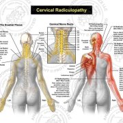 what-are-the-symptoms-of-cervical-radiculopathy.jpg What are the symptoms of cervical radiculopathy?