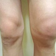 what-are-the-symptoms-of-knee-bursitis.jpg What are the symptoms of knee bursitis?