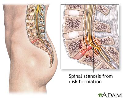 Is surgery always necessary for spinal stenosis?